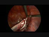 Laparoscopic Huge Ovarian Cystectomy • Video • MEDtube.net