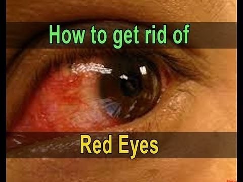 Red Eye Treatment - How to Get Rid of Red Eyes Fast