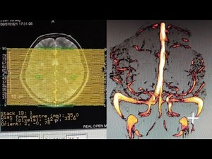 MRV (magmatic resonance venography)