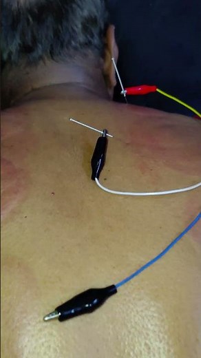 Acupuncture therapy reduce the back Pain feed #acupuncture #viralfeedshorts #dryneedlingtherapy #yt