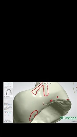 Designing a Crown in 3Shape