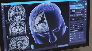 New eyesight correction procedure approved by FDA