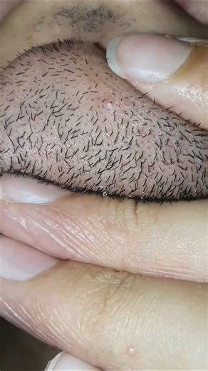 #hairgrowth #haircare #ingrownhairremoval #removehair #viralcontent