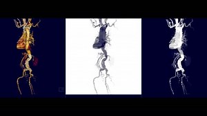 Cta Aorta Mip Completa Técnica Angiografía Mip Dar Vuelta Pantalla