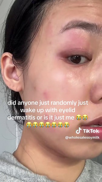 Eyelid Dermatitis: A Personal Experience and Hope