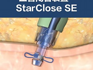 血管闭合装置- star close