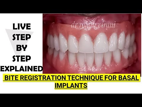 Bite Registration Technique For Basal Implants step by step explained - Dr Rohan Virani