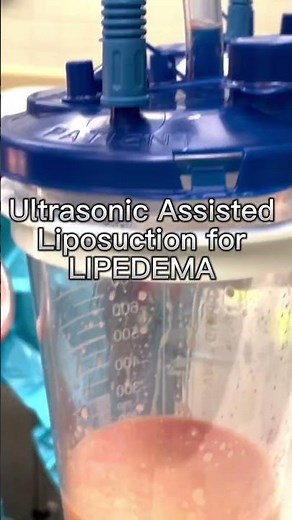 Lipedema Surgery - Lipedema Fat Removal - Before & After - Dr. Boris Volshteyn