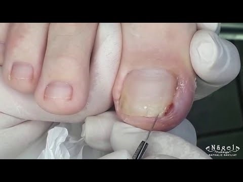 SHOCKED BY THE SIZE OF THE TOE NAIL THORN I REMOVED FROM HIS FOOT.