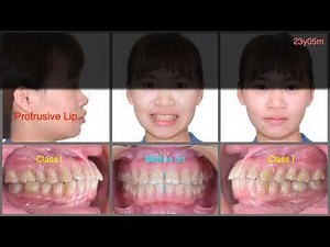 Atypical extraction strategy for bimaxillary protrusion treatment｜【Chris Chang Ortho】CC600