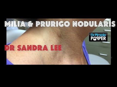 Milia extraction and a Prurigo Nodularis