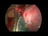 Uniportal VATS Resection of Complex Huge Bronchogenic Cyst • Video • MEDtube.net