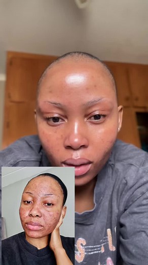 Transformation: My Acne Treatment Journey