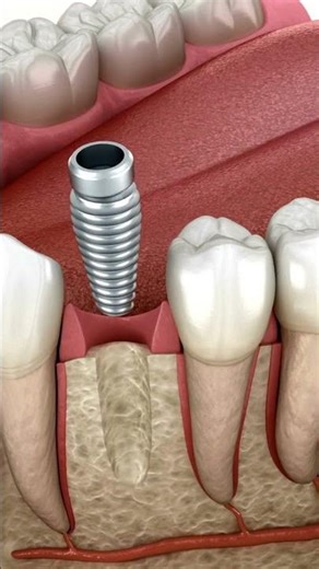 How a Dental Implant Is Placed in the Jawbone