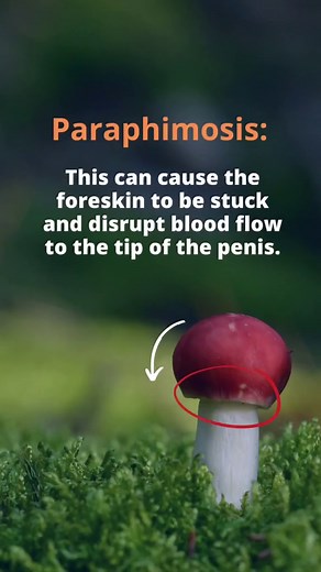 Understanding Paraphimosis: Symptoms, Causes, and Treatment