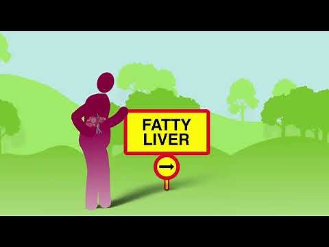 The stages of NAFLD (non-alcohol related fatty liver disease)