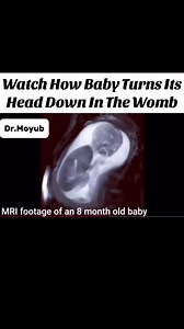 Watch how a baby attempts to turn its head down in the womb during pregnancy. #fblifestyle | Dr.Moyub Healthcare
