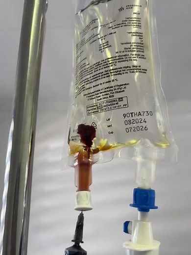 Understanding Anemia Symptoms and Iron Infusion Drips