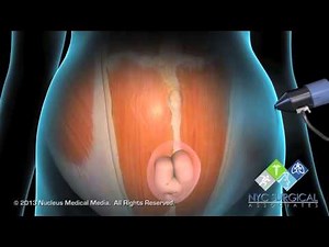 Ventral Hernia Repair