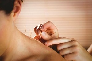 Debunking Top 5 Acupuncture Myths