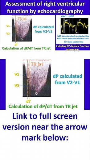 Assessment of right ventricular function by echocardiography