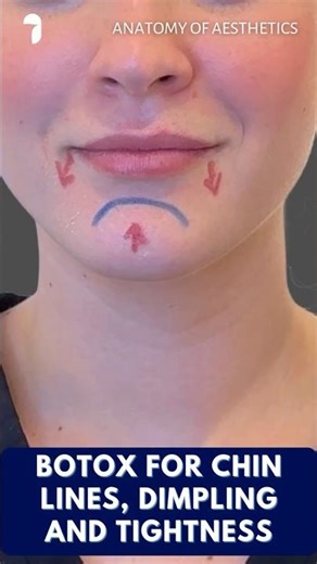 Botox for Chin Lines, Dimpling, and Tightness | Anatomy of Aesthetics