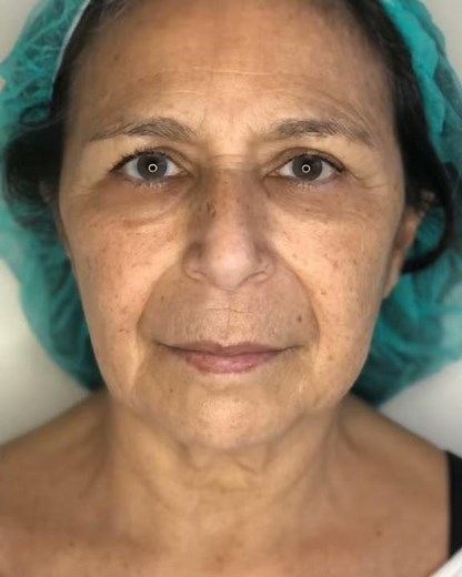 Absorbable PDO Thread Lift - Before and After - South Florida Center For Cosmetic Surgery Medspa