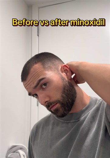 Transform Your Hair with Minoxidil Treatment