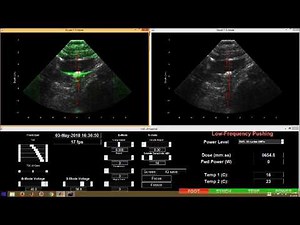 Ultrasonic Kidney Stone Treatment