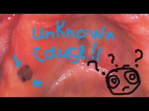 oral pigmentation : Malignant melanoma | oral medicine lecture 6