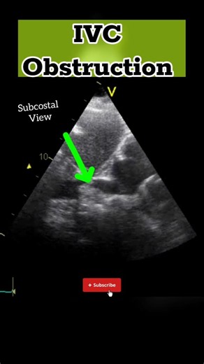 IVC Obstruction on Echocardiography
