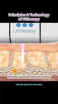 HIFU Ultherapy Guide✨｜Smart Lifting from Core Principles to SMAS Targeting