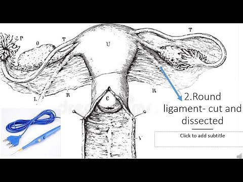 Learn how to perform a hysterectomy in 10 steps | Gynaecology made easy
