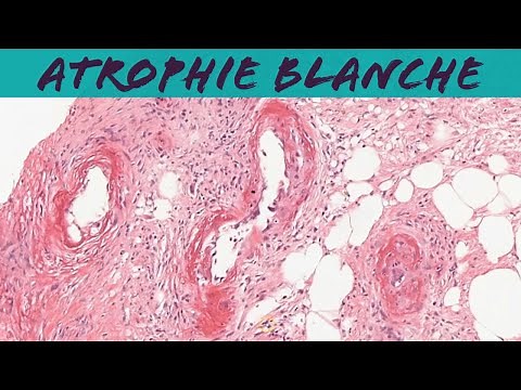 Atrophie blanche (livedoid vasculopathy) (dermatology dermpath pathology)