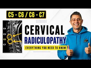 What is Cervical Radiculapathy and how to manage it for pain relief #cervicalradiculopathy