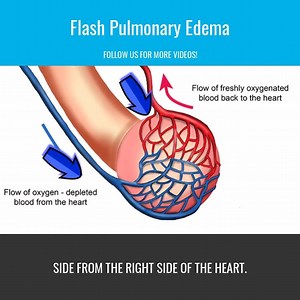 15K views · 61 reactions | Pathophysiology of Flash Pulmonary Edema Struggling in EMT or Paramedic School? Join our FB group and crush that stress! https://www.facebook.com/groups/1153328328045266/ | Master Your Medics | Facebook