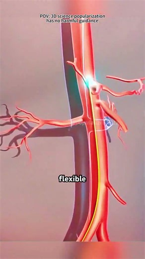 Mechanical Thrombectomy Procedure (3D Animation)