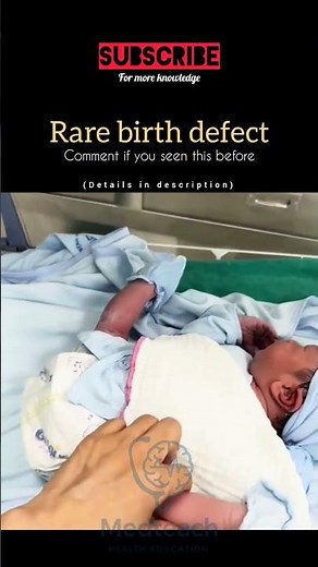 👶 “What Are Congenital Birth Defects? | Hidden Facts You Must Know!” #developmentalpediatric
