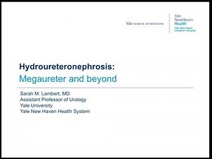 5.26.2020 PedsUroFLO Lecture - Hydroureteronephrosis: Megaureter and Beyond