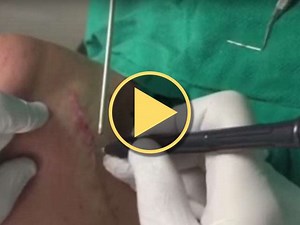 LightScalpel CO2 Laser Scar Revision - LightScalpel