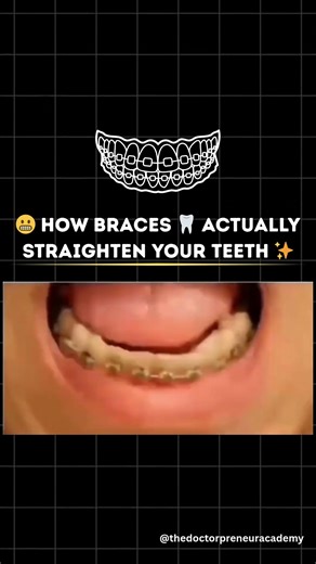 😬 How braces 🦷 actually straighten your teeth ✨