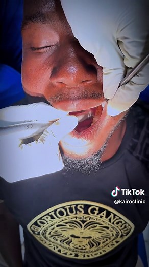 Danga am pakh sa Bonj b wala lu dark? 🦷 Here is a teeth filling procedure.. . . . . . . . . . . . . . . . . . . . . . . . #kairoclinic #teethfilling #teeth #fypp #teethcleaning #gambian_tiktok🇬🇲🇬🇲 #dental #oralhealth #viral_video . . . . . . . . .