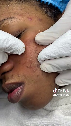 Conseils pour une Belle Peau : Points Noirs et Acné