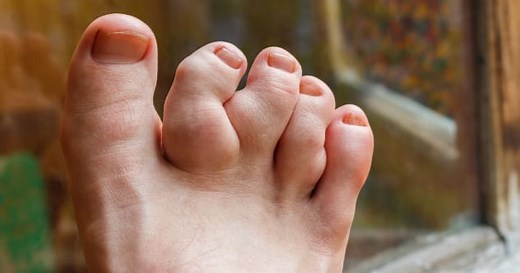 10 Celebrities You Didn't Know Had Deformities