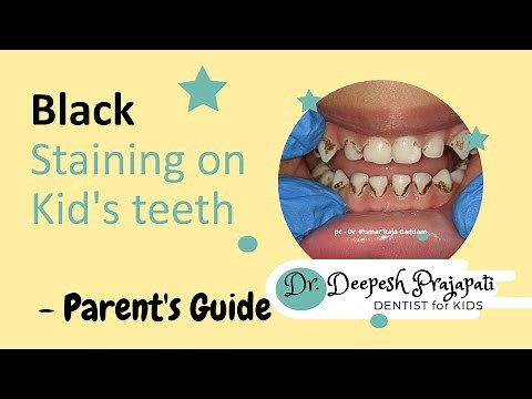Black staining on kid's teeth - Guide for Parents