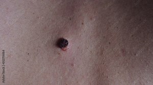 Examining seborrheic keratosis after Cryotherapy on the back skin. Macro.