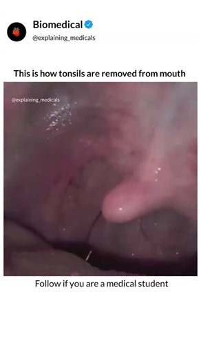 Explaining Medicals on Instagram: "Follow @explaining_medicals ⬇️⬇️⬇️⬇️ What text books can't show you, We animate. Tonsil stones (tonsilloliths) form when debris, bacteria, and dead cells get trapped in tonsil crevices, calcifying into small, hard masses. Poor oral hygiene, chronic tonsillitis, and large tonsils can contribute to their formation. They can cause bad breath, sore throats, and discomfort, but are usually harmless . . . . . 📝 | Hard Concepts, Simplified in 30 Seconds 📚 | Tired Of