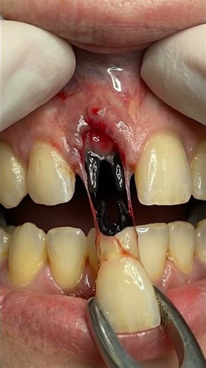Removing Heavy Plaque and Tartar – Yellow buildup cleaned to white teeth #dentaltips #toothcare