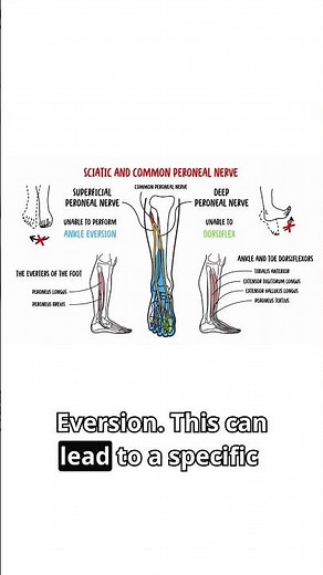 What happens when the nerve that lifts your foot stops working?🦶⚡ #neuroanatomy #footdrop #meded