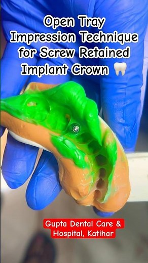 Open Tray Impression Technique #implant #implantdentist #implantdenture #dentist #trending #viral